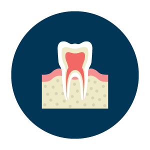 Root Canal