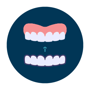 Clear Aligner